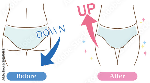 美尻　お尻のたるみ　ビフォーアフター　イラスト