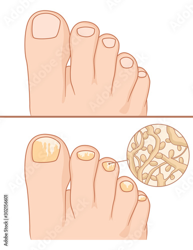 Foot with nail fungus and healthy foot