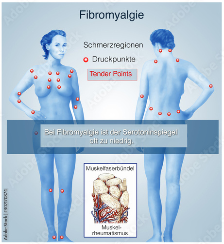Fibromyalgie. Dauerschmerz photo