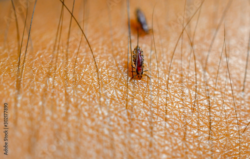 Louse, Head lice feed on blood on human skin.