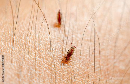 Canvastavla Louse, Head lice feed on blood on human skin.