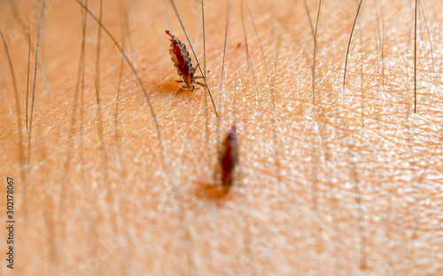 Louse, Head lice feed on blood on human skin.