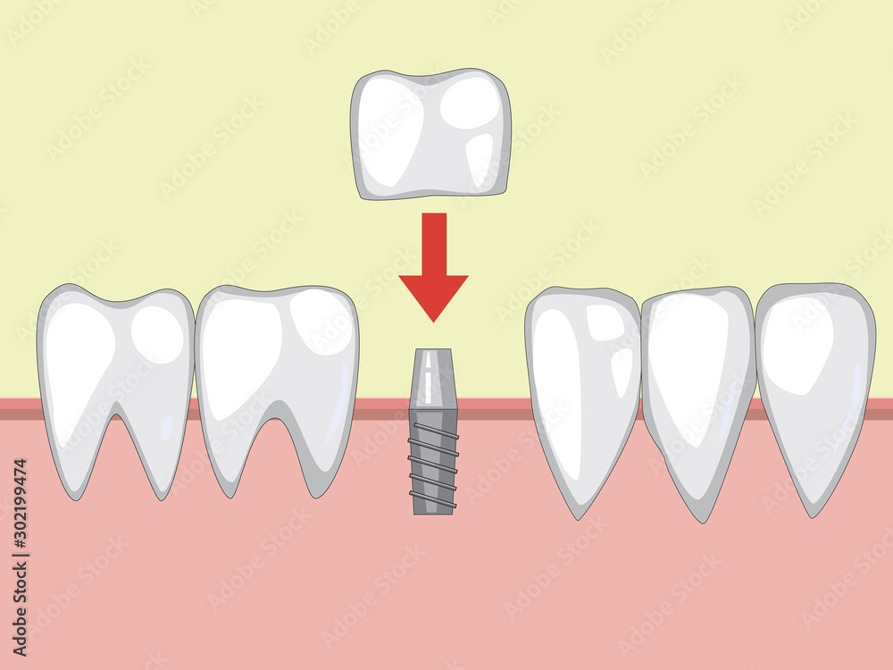 A tooth implant on a metal pin, a vector illustration with molar prostheses  on the gum for an orthodontist or dentist Stock Vector | Adobe Stock