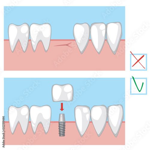 A molar tooth implant before and after the dentist, a vector stock concept for orthodontic clinic
