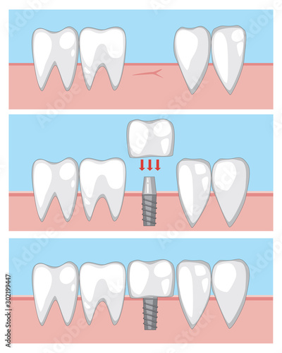 A molar implant on the gum, a vector infographics with the process of installing a tooth on a metal pin by an orthodontist