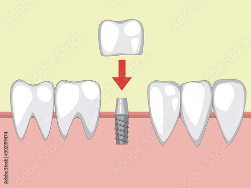 A tooth implant on a metal pin, a vector illustration with molar prostheses on the gum for an orthodontist or dentist