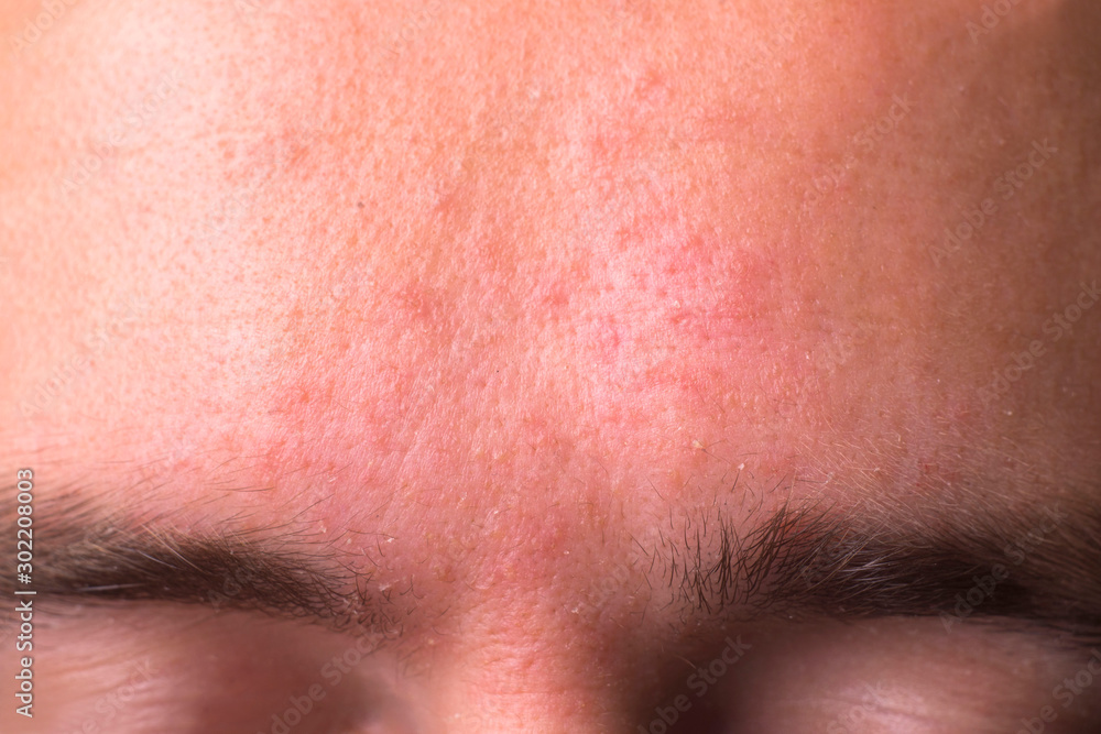 weeping eczema in the stage of exudation. Closeup of forehead area with