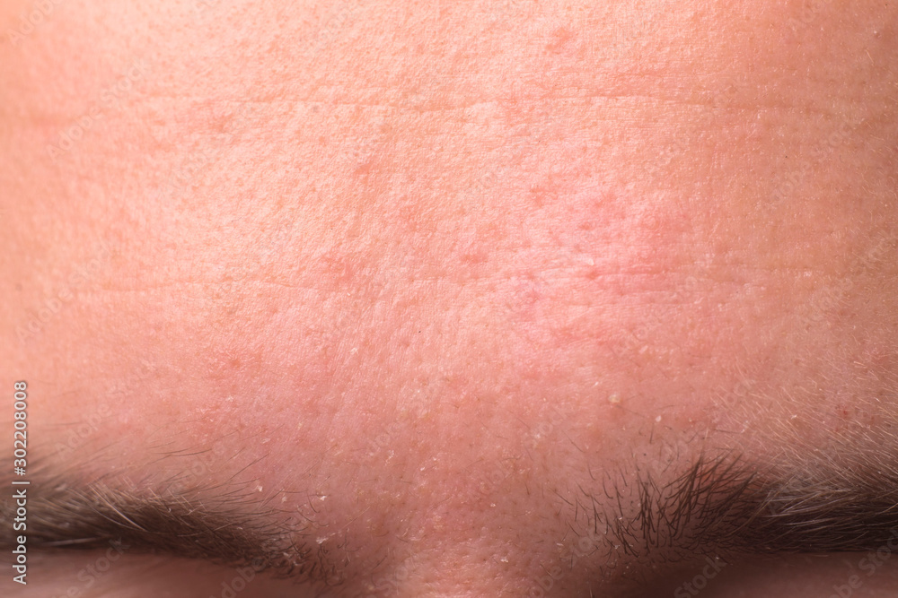 weeping eczema in the stage of exudation. Closeup of forehead area with eczema rash clinic