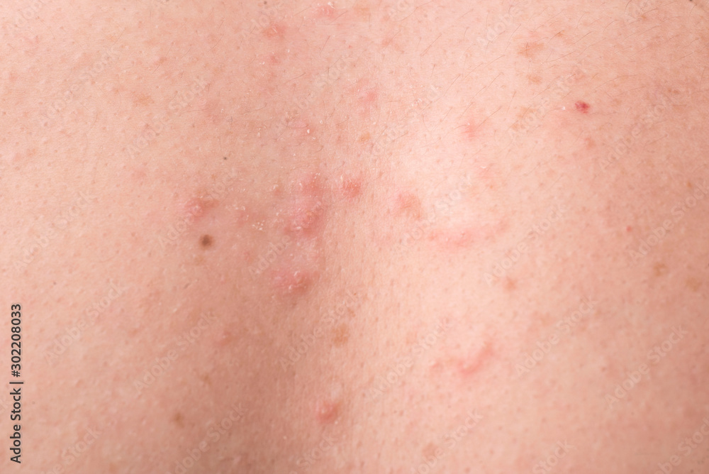 streptococcal skin infection, in the form of rash elements. Folliculitis of the of the back. Stock Photo | Adobe Stock