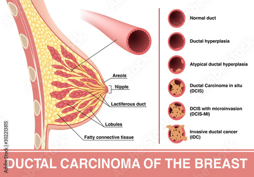 Breast cancer. Ductal carcinoma. DCIS and IDC. Vector illustration showing cross section of female breast and lactiferous duct with different cancer stage.