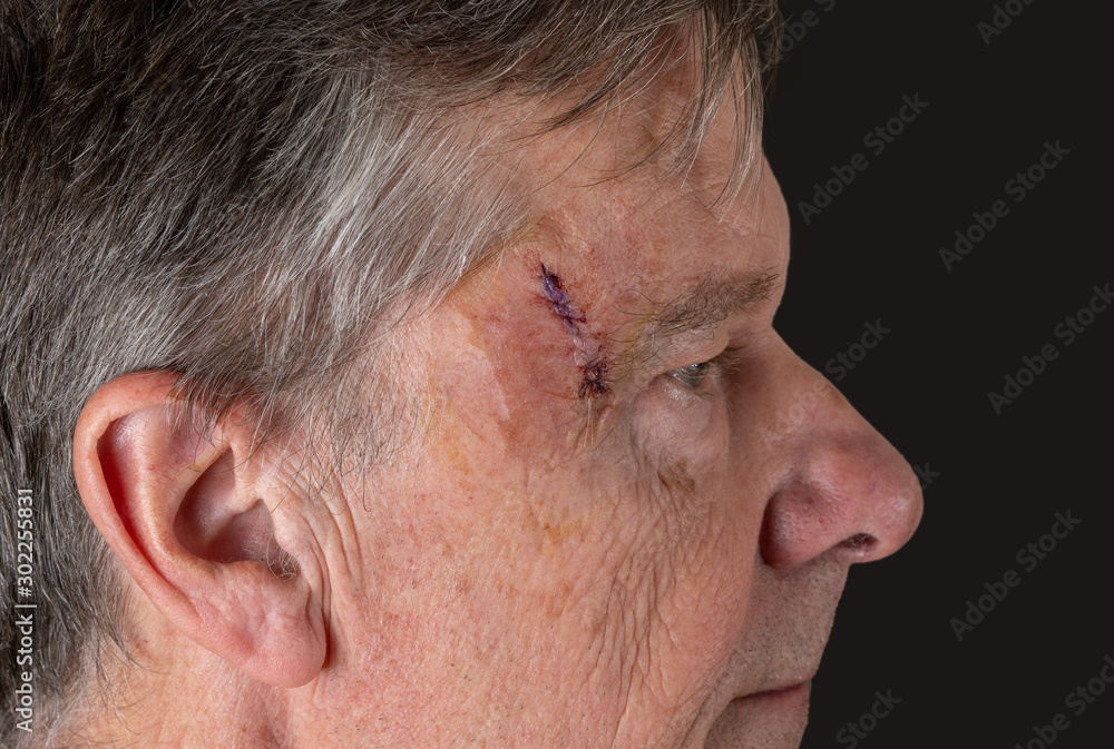 Senior adult male with stitches in the cut after surgery for removal of basal cell carcinoma caused by sun damage Senior adult male with stitches in the cut after surgery for removal of basal cell carcinoma caused by sun damage