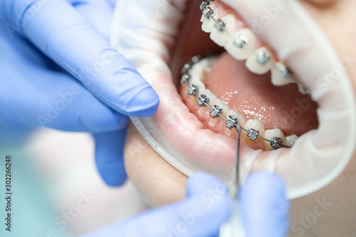 Close-up of teeth with braces. Dentistry and the procedure for adjusting iron braces on the teeth in the patient's mouth. photo