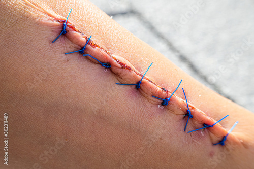 Wound with suture after surgery
