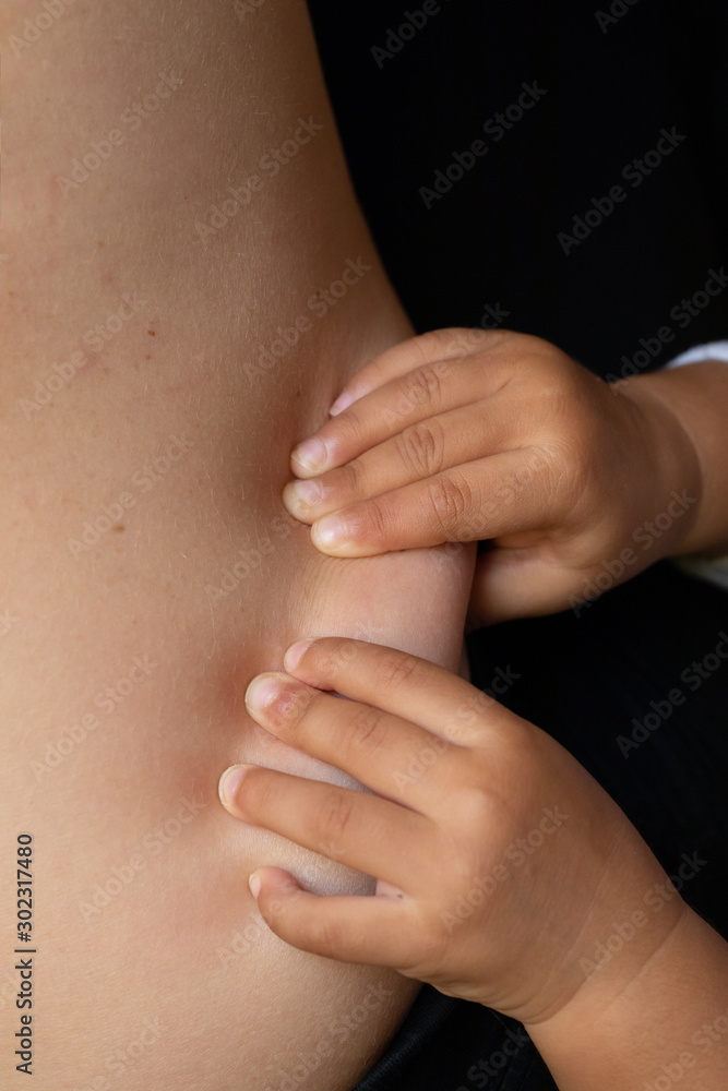 Child holding excess skin on mother body