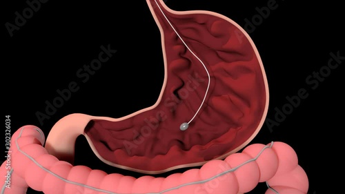 Insertion Of The Gastric Balloon photo