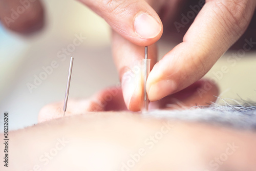 Man on acupuncture