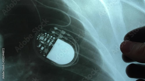 Doctor Examining X-Ray Image of Chest with Artificial Cardiac Pacemaker Implant photo