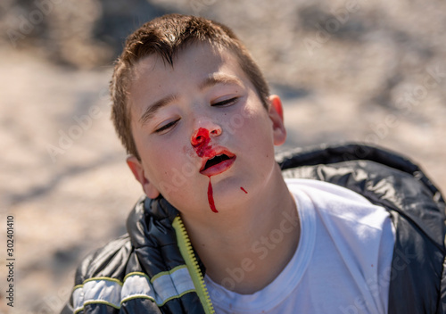 Boy ten years old with his nose bleeding
