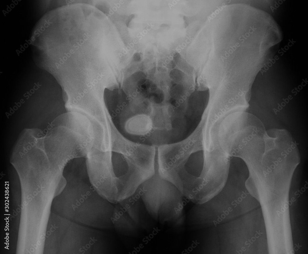 Xray image of bladder, Showing bladder stone Photos Adobe Stock