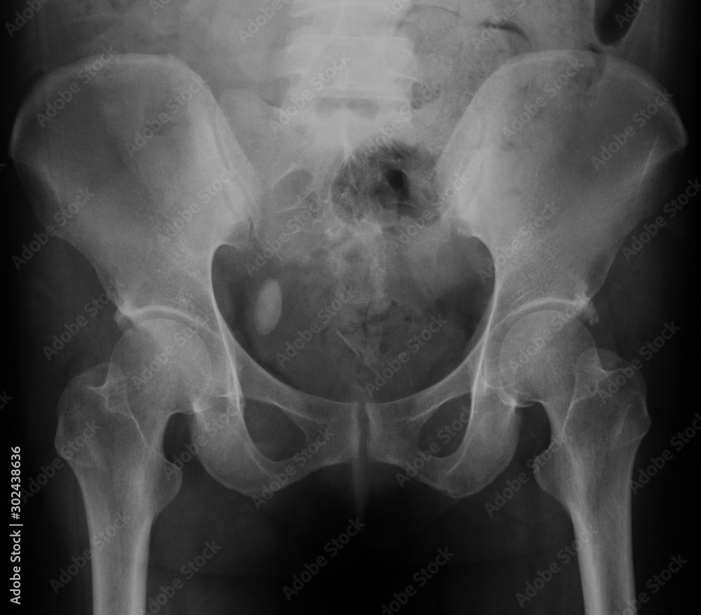 Xray image of bladder, Showing bladder stone Stock Photo Adobe Stock