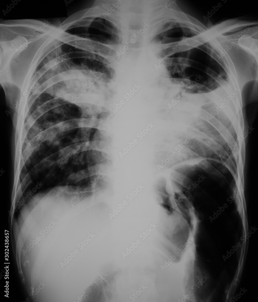 Chest x-ray image showing bilateral lung ingfection. Chest x-ray image showing bilateral lung ingfection.