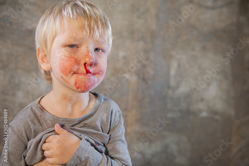 little fair-haired boy is smeared with blood. baby has weak vessels in nose bursting with pressure drops and changes in weather. Hemophilia disease. Blond child lifts his head to stop the bleeding