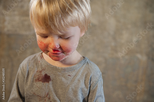 little fair-haired boy is smeared with blood. baby has weak vessels in nose bursting with pressure drops and changes in weather. Hemophilia disease. Blond child lifts his head to stop the bleeding photo