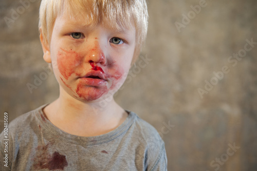 little fair-haired boy is smeared with blood. baby has weak vessels in nose bursting with pressure drops and changes in weather. Hemophilia disease. Blond child lifts his head to stop the bleeding