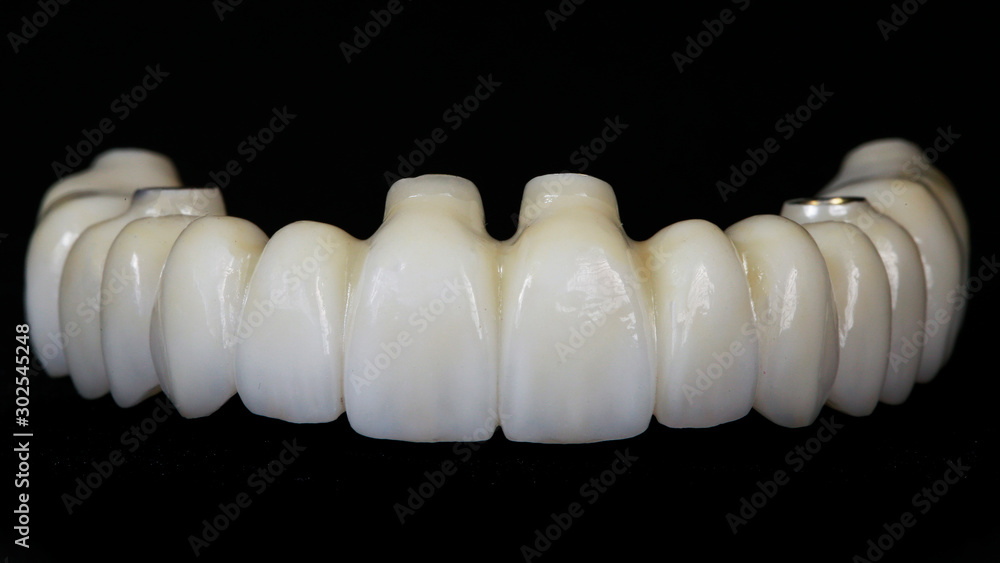 dental prosthesis from zircon on implants on a black background dental prosthesis from zircon on implants on a black background