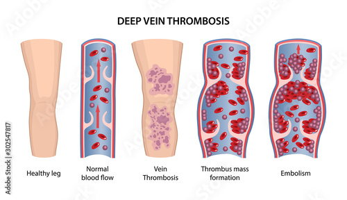 Deep vein thrombosis. Image of healthy and diseased legs. A longitudinal section of a veins with a description of the main stages. Vector illustration in flat style isolated on white background photo