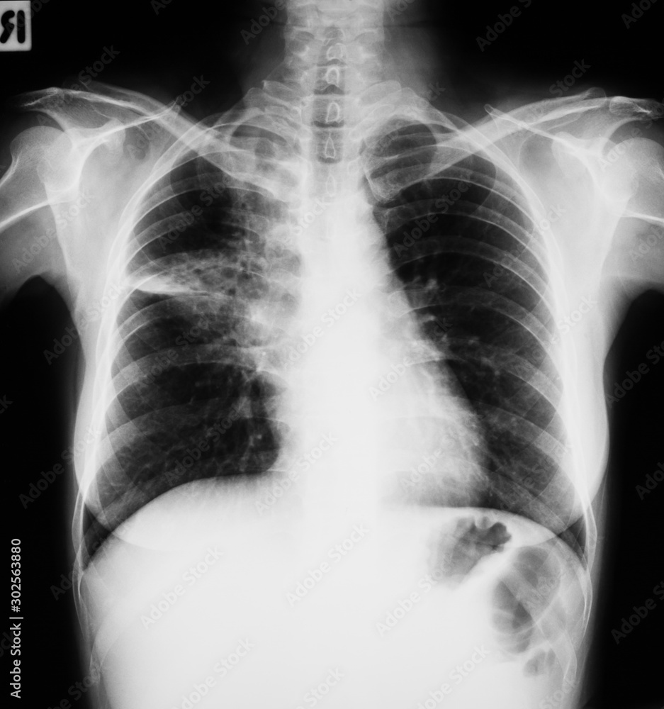Chest X-ray image, posteroandterior (PA) uprigt position (R=right side). lung infection Chest X-ray image, posteroandterior (PA) uprigt position (R=right side). lung infection