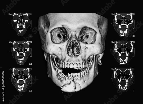 Computed tomography (CT) scan of facial bone, a case of mandibular fracture