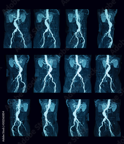 Computed tomography angiography (CTA) of the abdomen and pelvis  photo