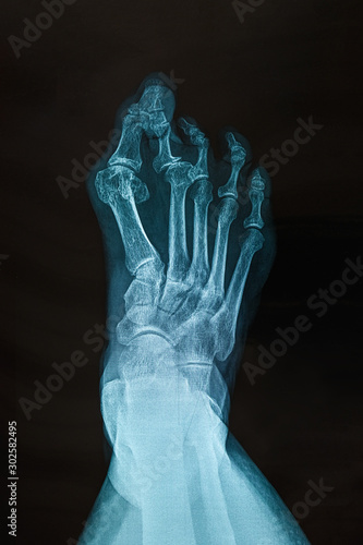 Valokuva X-ray of the right foot