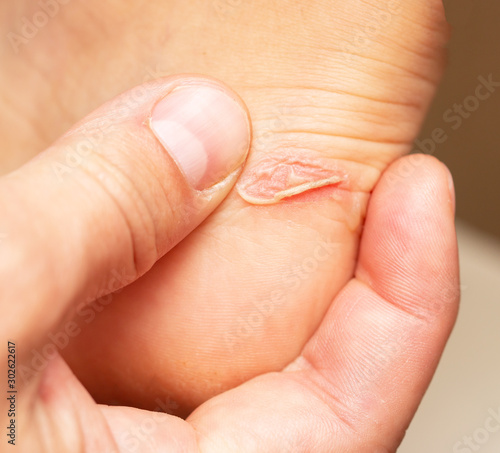 grated blown callus on the foot on the skin