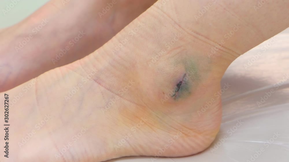 Surgeon bends and unbends patient's leg checking mobility of ankle joint after surgery to removal hygroma. Recovery, rehabilitation, therapy and treatment after surgery. Wound healing with stitches. Surgeon bends and unbends patient's leg checking mobility of ankle joint after surgery to removal hygroma. Recovery, rehabilitation, therapy and treatment after surgery. Wound healing with stitches.