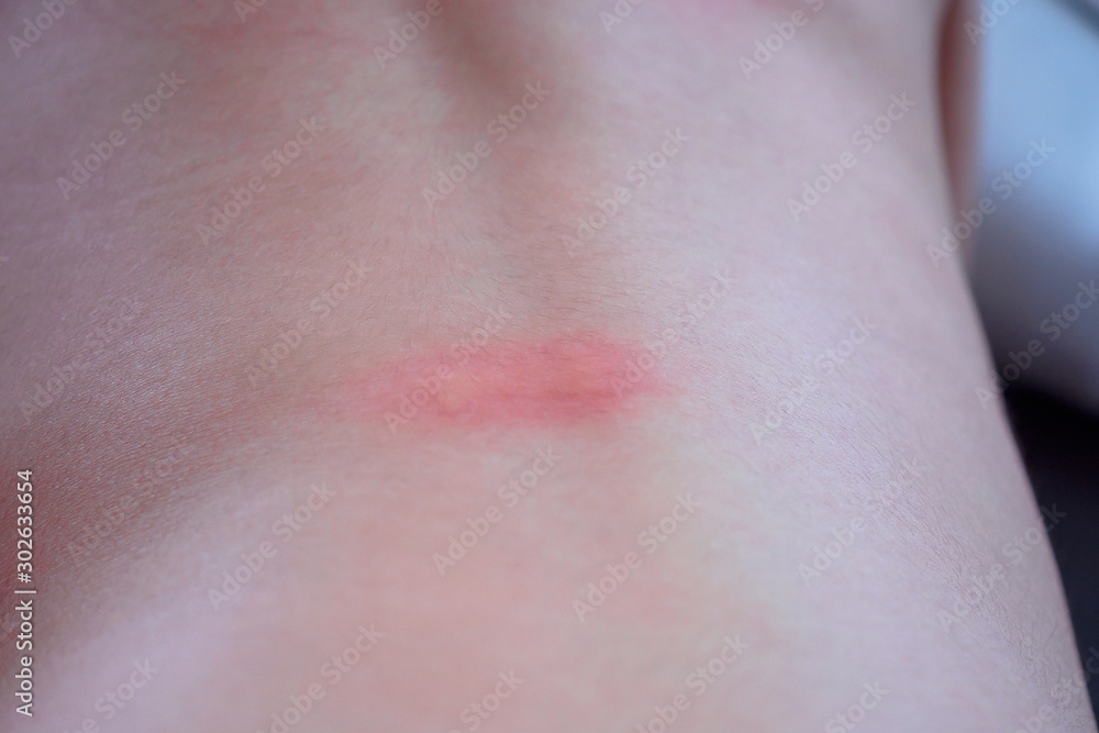 little asian girl skin rash and allergy with red spot cause by mosquito bite at back little asian girl skin rash and allergy with red spot cause by mosquito bite at back