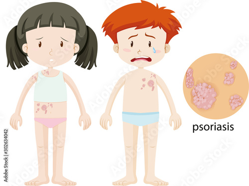 Boy and girl with psoriasis