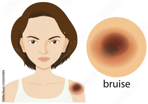 Woman with bruise on skin