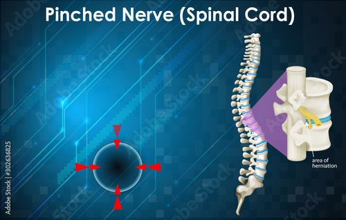 Diagram showing pinched nerve