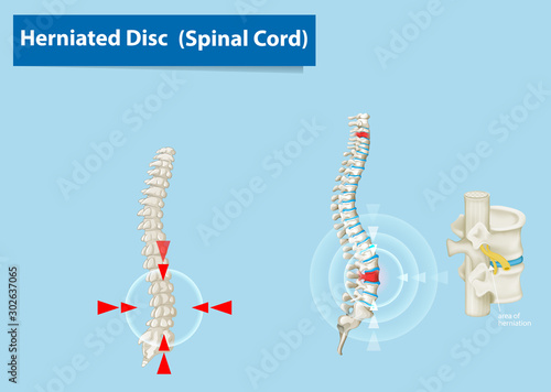 Diagram showing herniated disc in human