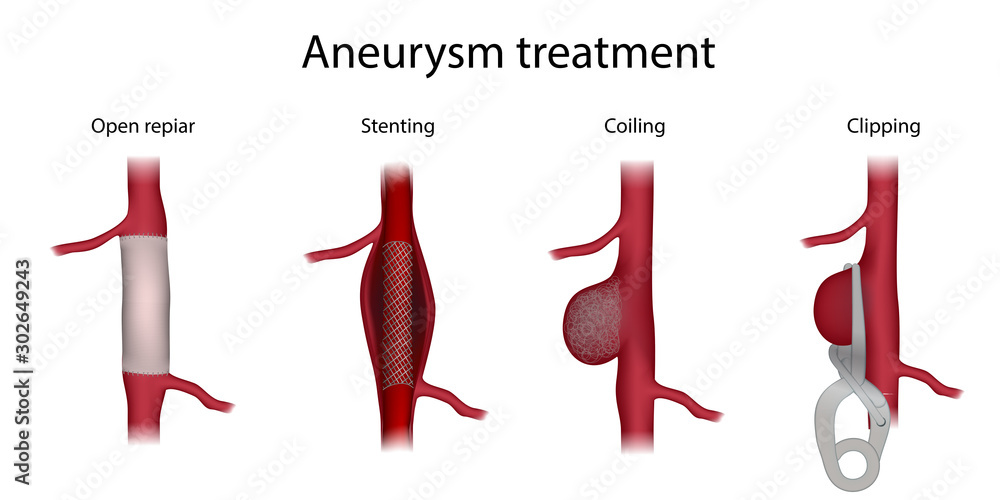 Aneurysm treatment. Clipping, open surgery repair, stenting, coiling