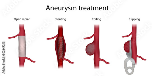 Aneurysm treatment. Clipping, open surgery repair, stenting, coiling. Medical anatomy illustration. photo
