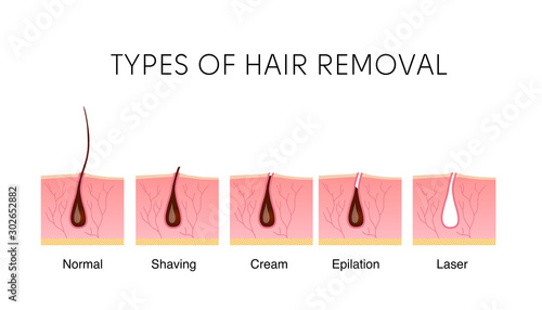 Comparison of the popular methods of hair removal: shaving, cream, epilator, and laser. Anatomy infographics vector illustration.