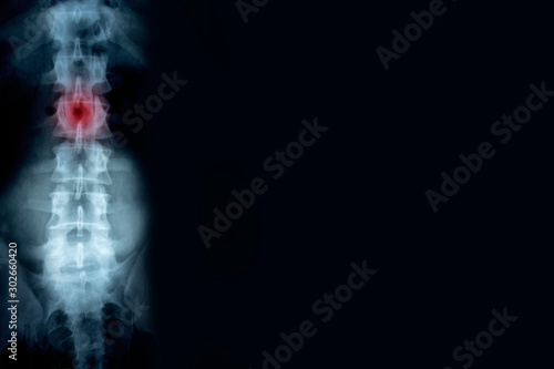 X-ray of the spine with a place of injury with copy space