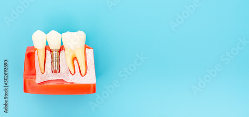 Plastic samples of dental implants compare with natural teeth.