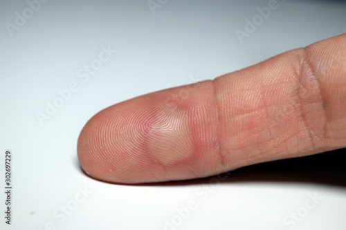 Close up of a finger with a blister on it with a white background. Domestic injury due to burning.