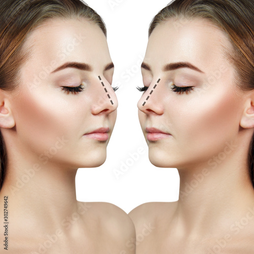 Female nose before and after plastic surgery. photo
