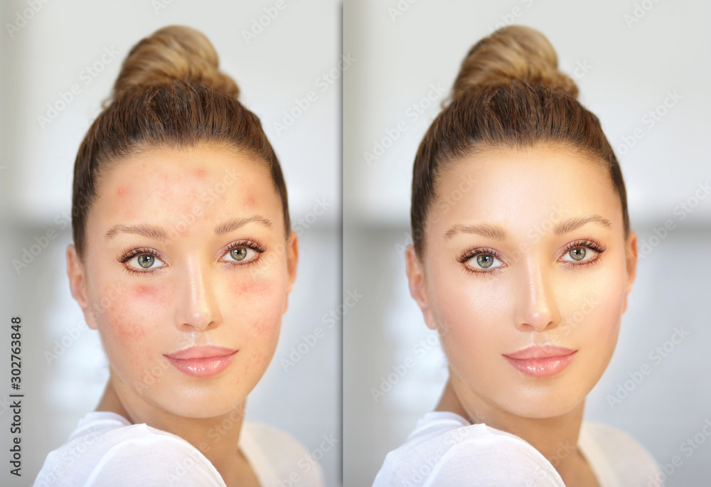Post-Acne Marks /Treating Acne Scars.Acne Scar Removal Post-Acne Marks /Treating Acne Scars.Acne Scar Removal