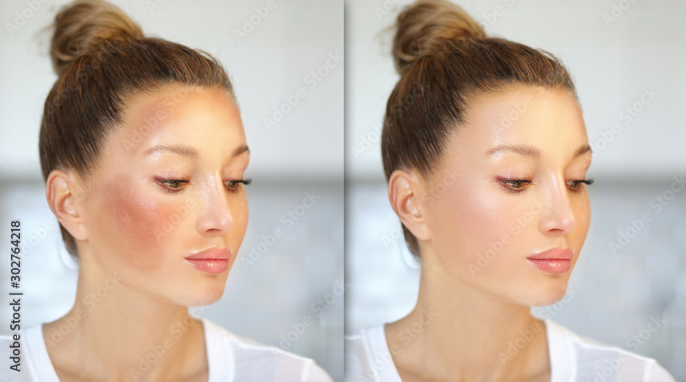 Dark spots, freckles,hyperpigmentation(melasma or chloasma) Dark spots, freckles,hyperpigmentation(melasma or chloasma)
